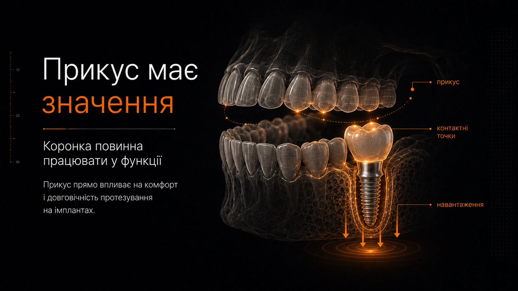 Цифрова схема прикусу з коронкою на імпланті та позначенням жувального навантаження.