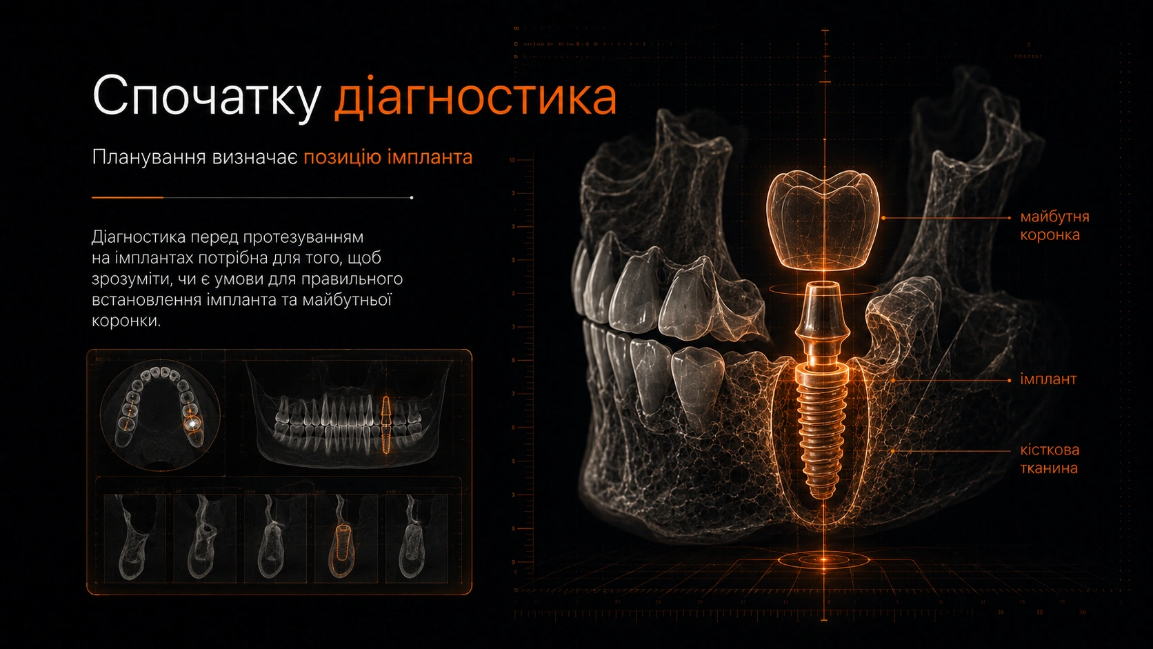 CBCT-візуалізація щелепи з плануванням позиції імпланта та майбутньої коронки.