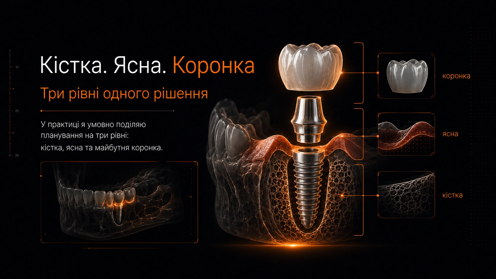 3D-модель імпланта, абатмента та коронки як елементів відновлення зуба на імпланті.