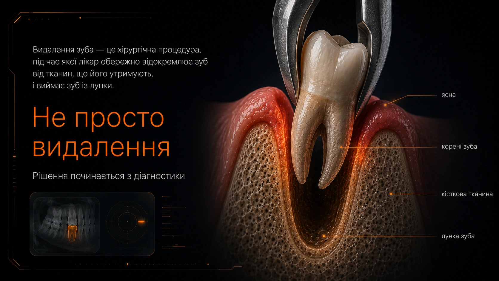 3D-модель зуба з коренями в кістковій тканині для пояснення видалення зуба.