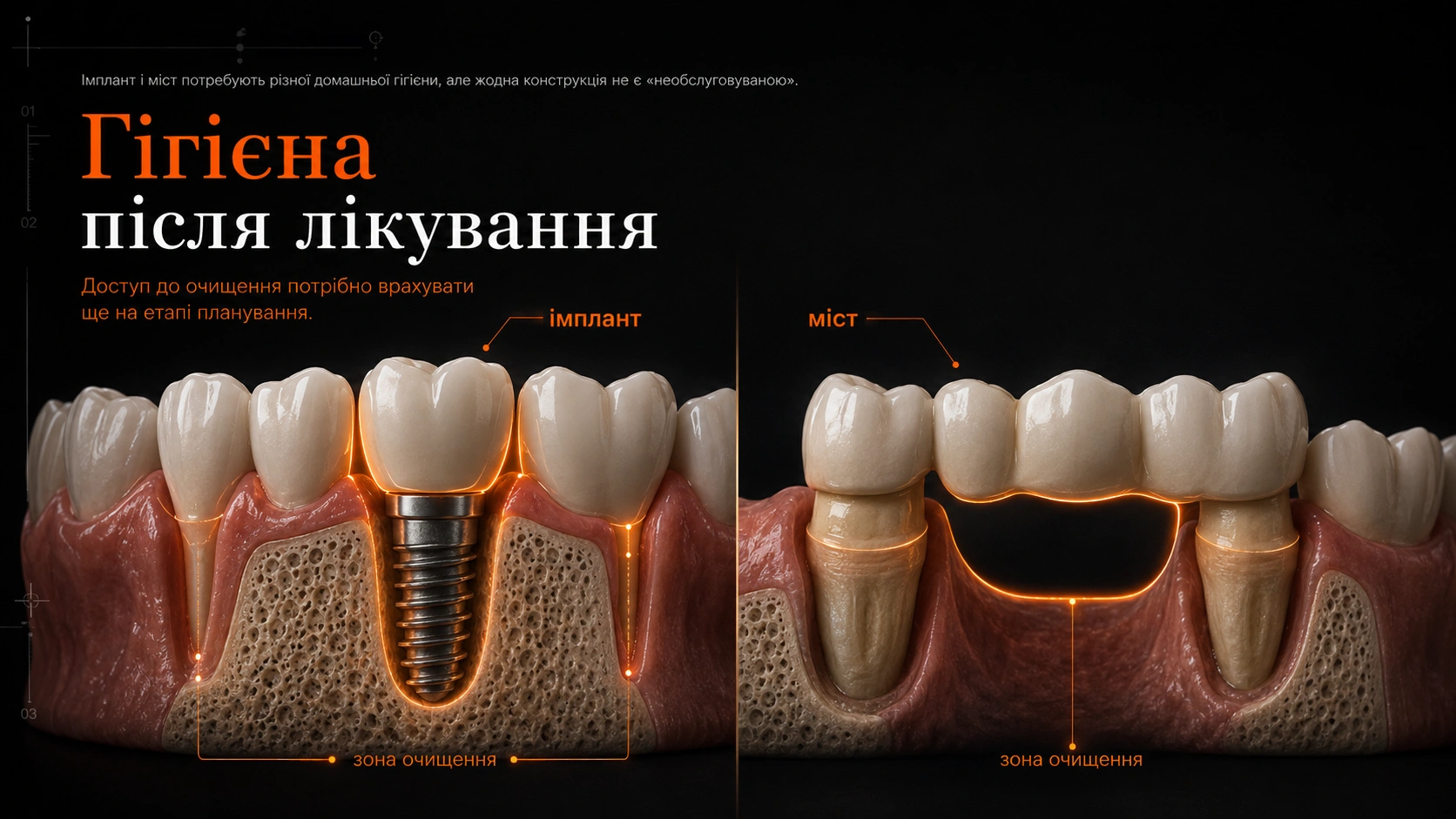 3D-схема зубного моста на сусідніх зубах із коронками