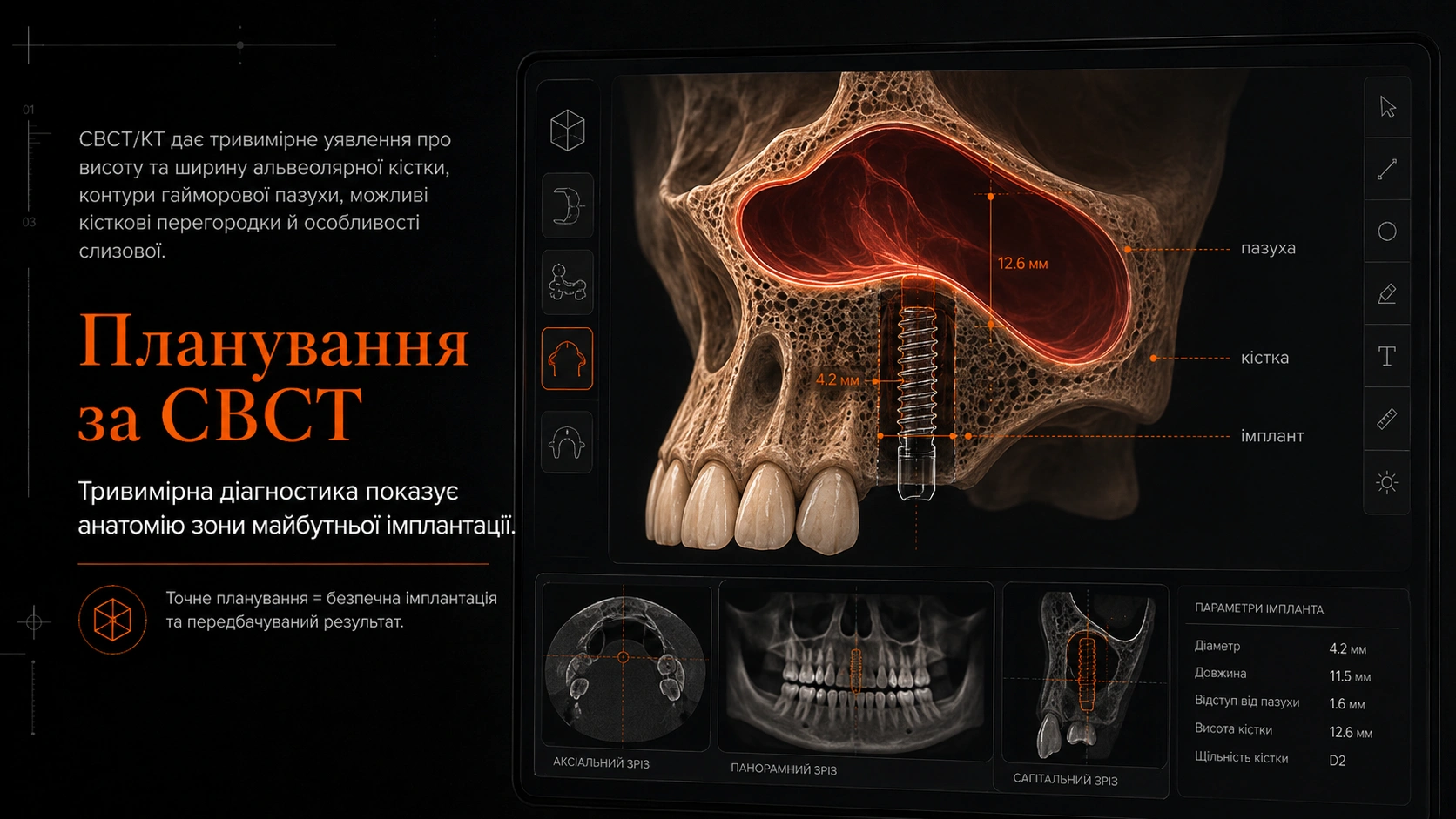 CBCT-візуалізація верхньої щелепи для планування імпланта біля гайморової пазухи