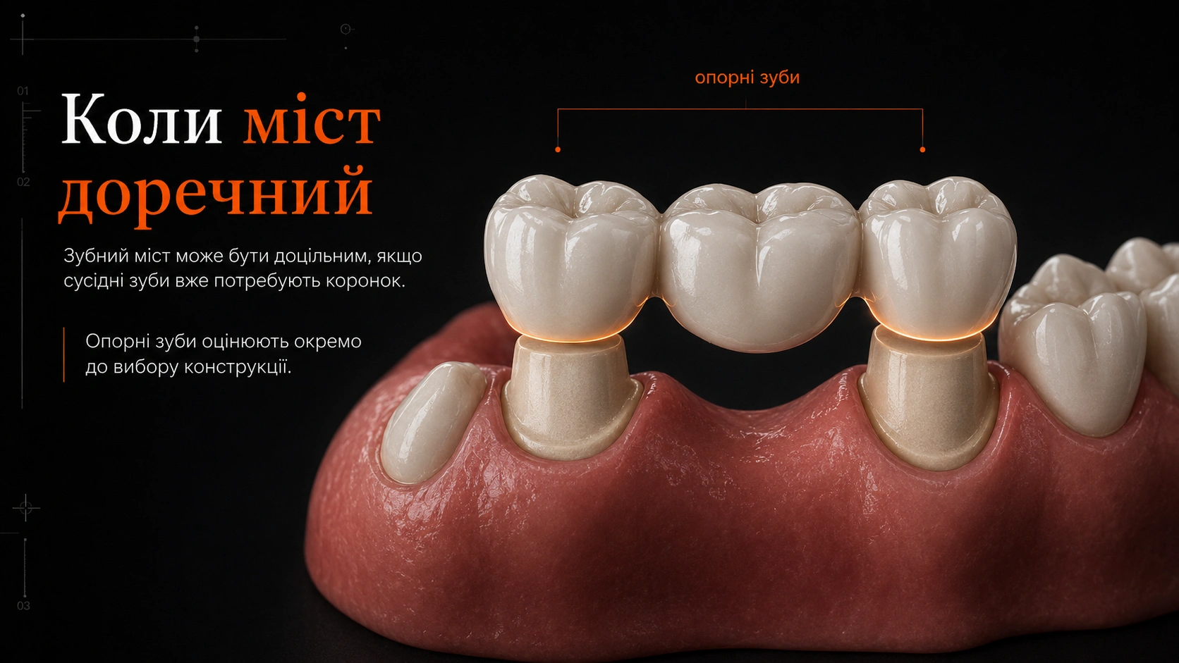 Імплант чи міст, схема імпланта як окремої опори та моста, що спирається на сусідні зуби