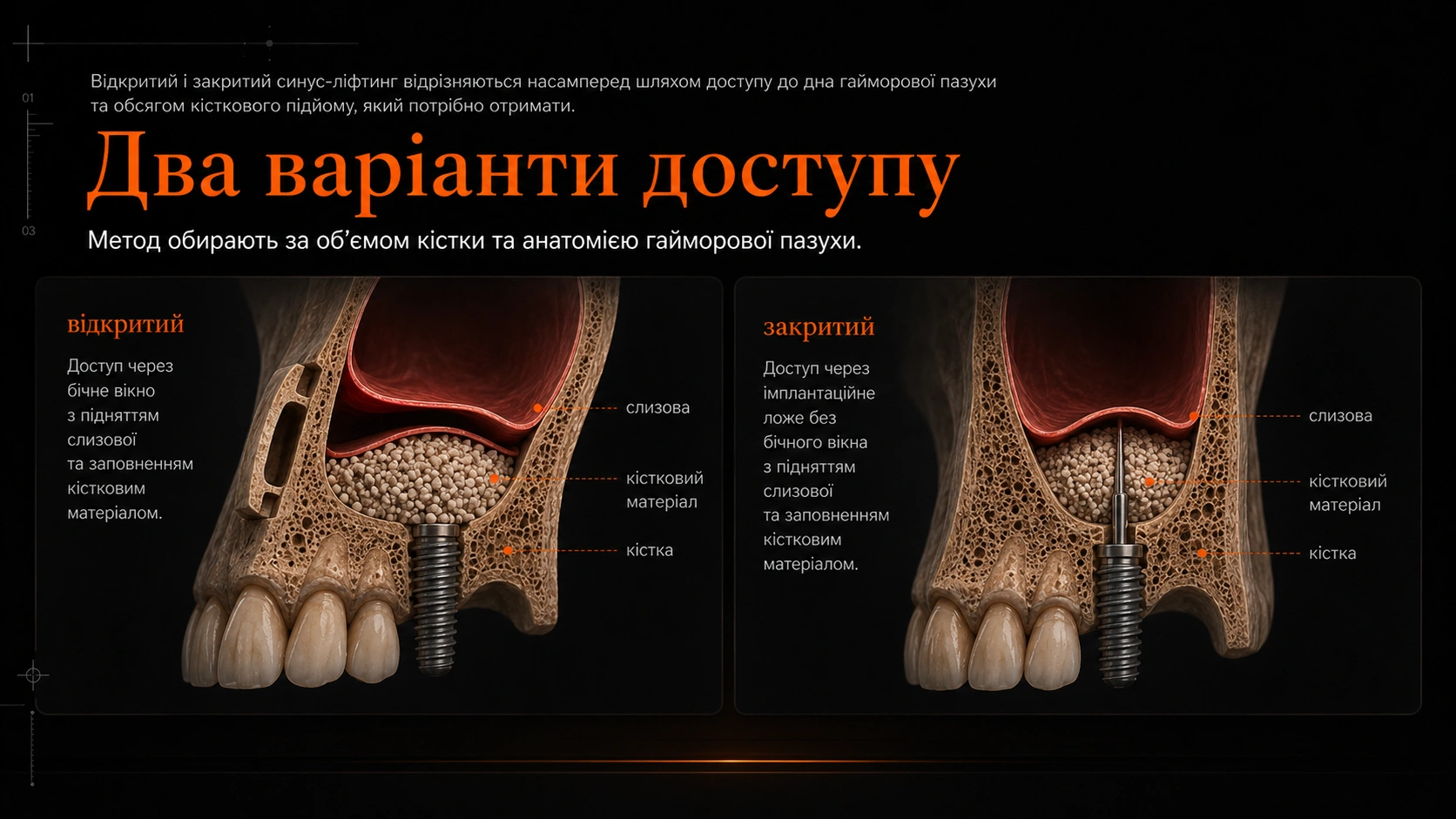 3D-схема загоєння кісткового матеріалу під слизовою гайморової пазухи