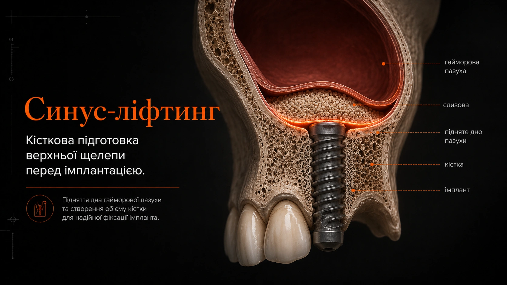 3D-анатомія верхньої щелепи з дефіцитом кістки під гайморовою пазухою