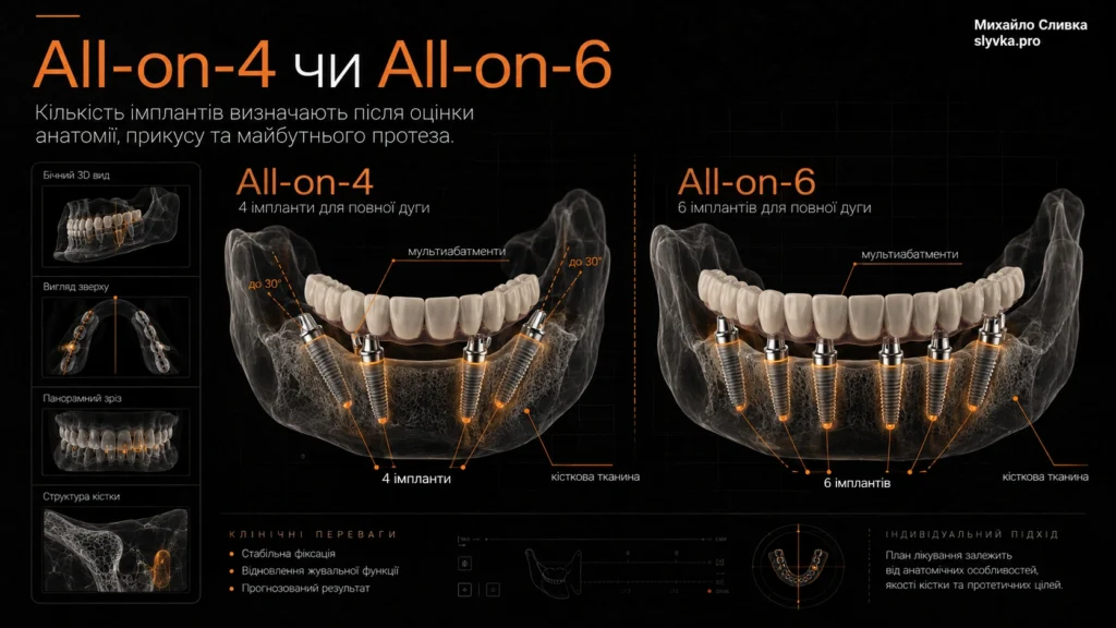 All-on-4 і All-on-6: незнімні зуби на імплантах