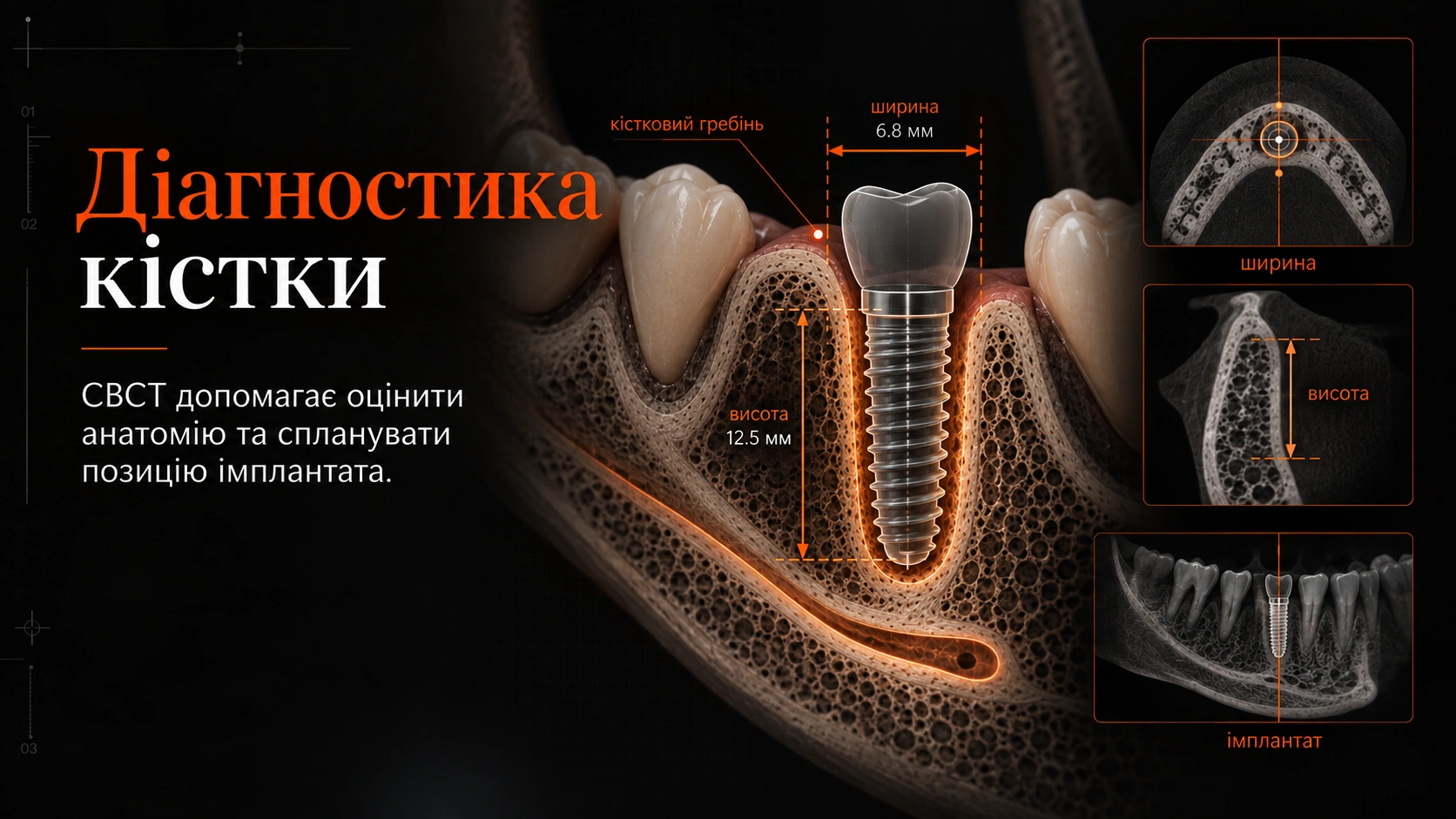 CBCT-зріз щелепи з вимірюванням кісткового гребеня та позицією імплантата
