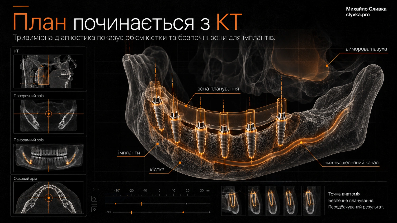 CBCT-візуалізація щелепи з цифровим плануванням позицій імплантів для повнощелепної реабілітації