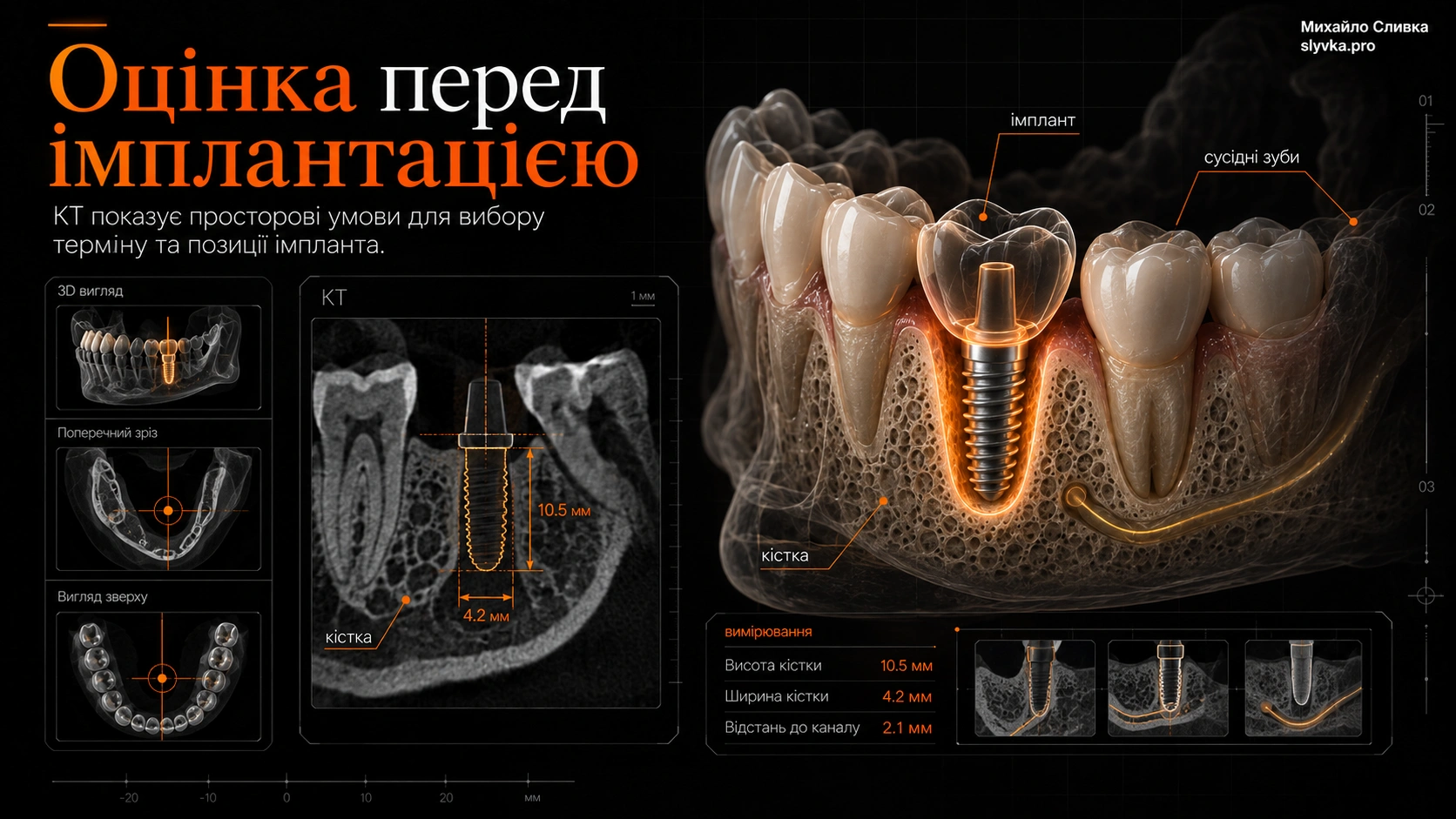 КТ-оцінка перед імплантацією CBCT-візуалізація щелепи з оцінкою кістки в ділянці майбутнього імпланта