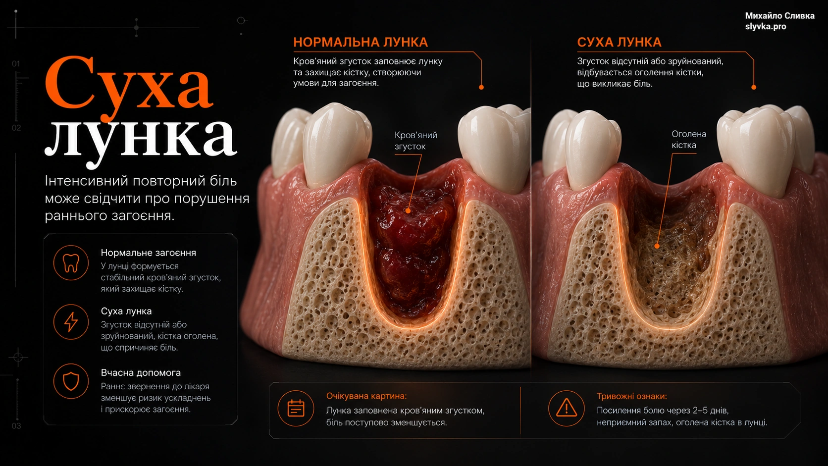 Схематична 3D-анатомія лунки після видалення зуба з нормальним згустком і порушеним загоєнням