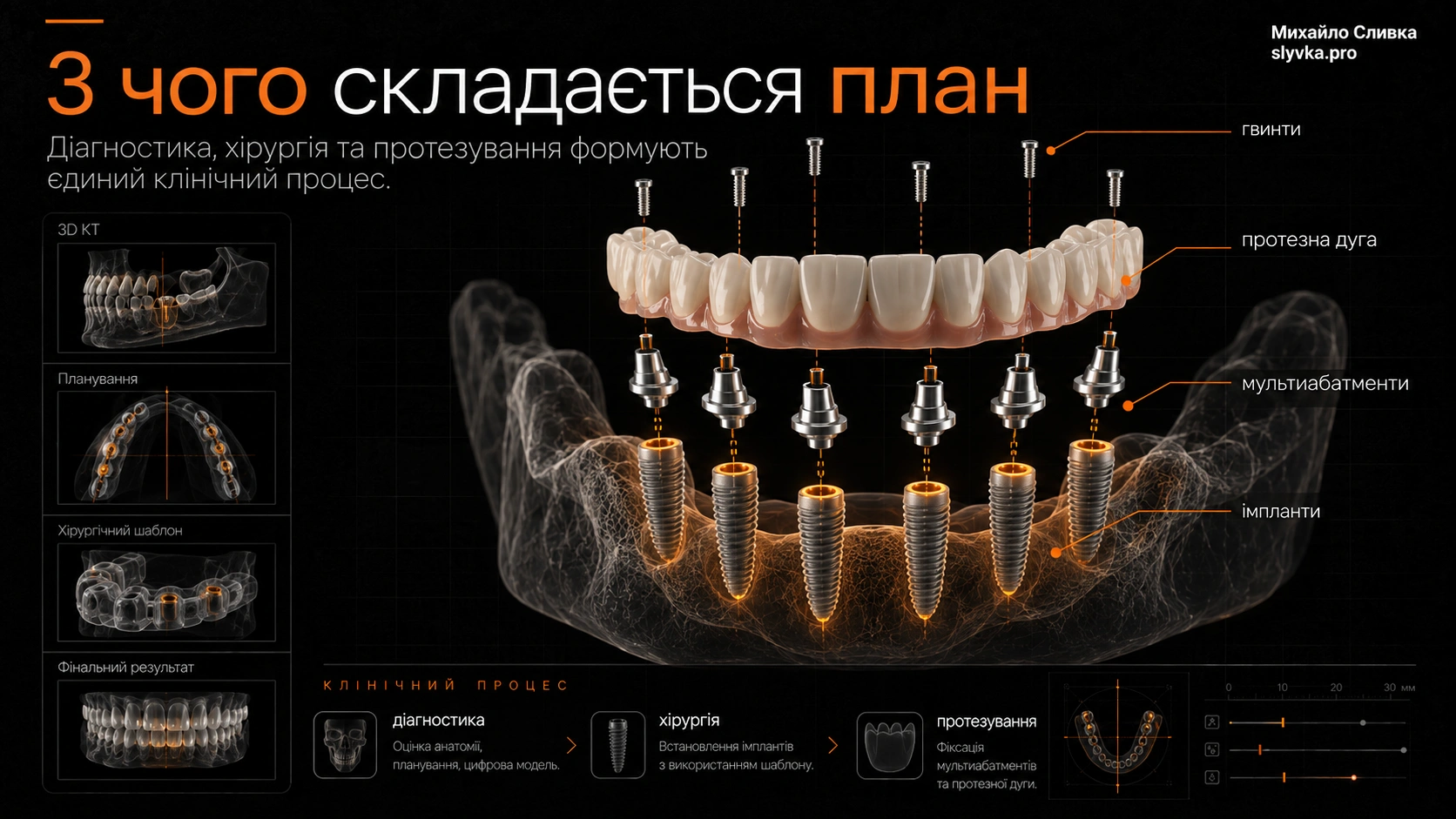 Розкладена 3D-конструкція повнощелепного протеза з імплантами, абатментами та протезною дугою