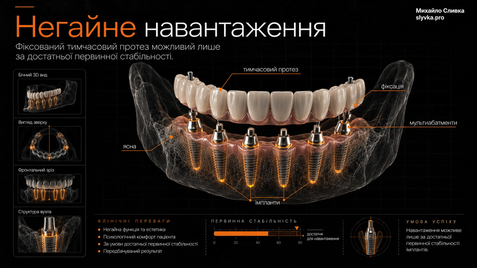 3D-схема тимчасового повнощелепного протеза, зафіксованого на імплантах після встановлення