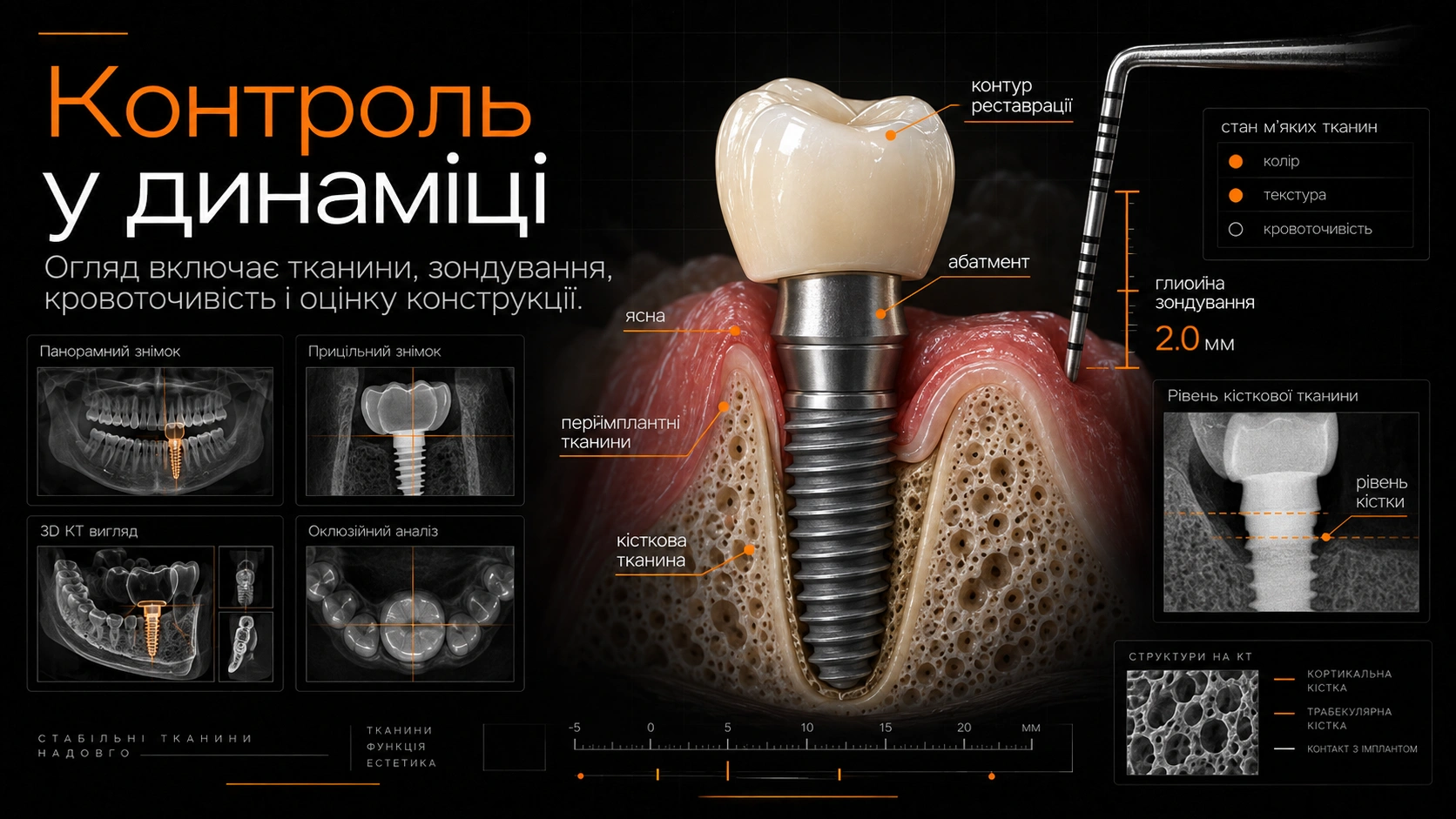 Схема імпланта з яснами, шкалою зондування та рентгенівським фрагментом рівня кістки