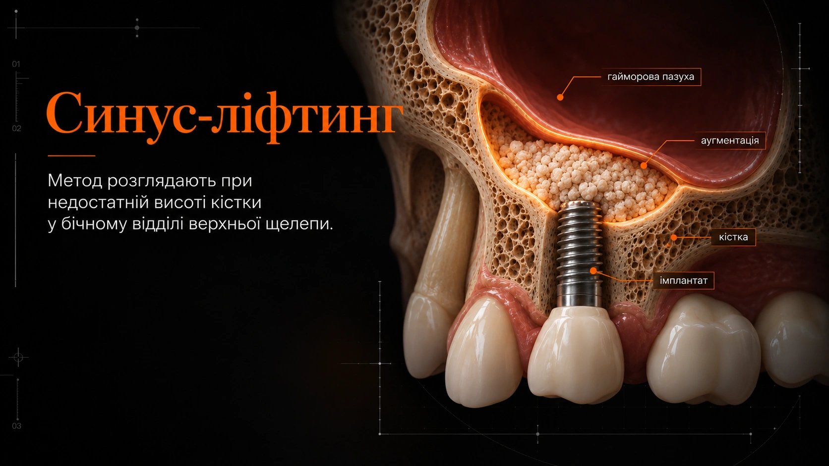 3D-схема верхньої щелепи з гайморовою пазухою, кістковою аугментацією та імплантатом