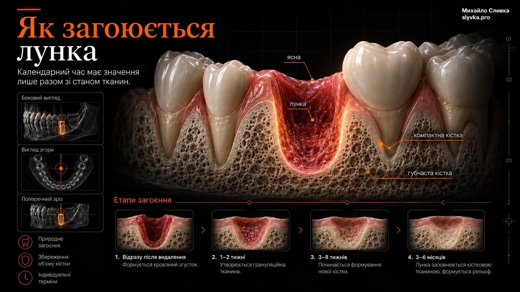 Загоєння лунки після видалення 3D-схема загоєння лунки та ремоделювання кістки після видалення зуба