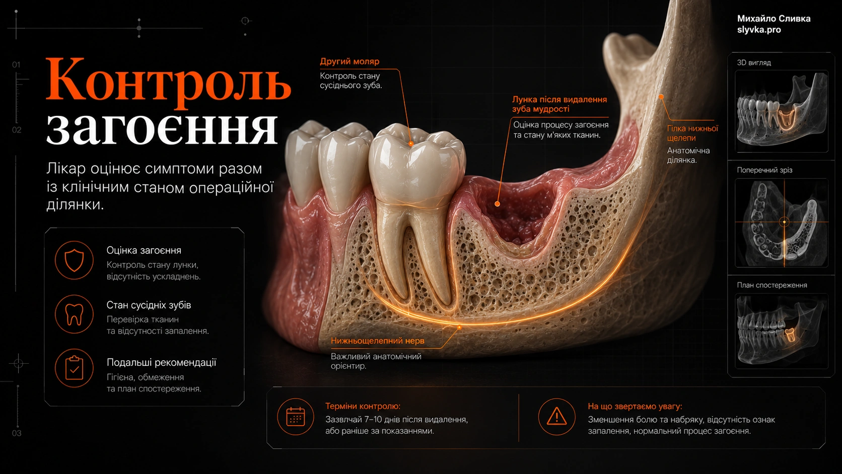 Цифрова 3D-візуалізація нижньої щелепи та лунки після видалення третього моляра